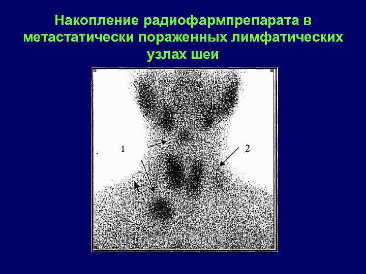 Накопление радиофармпрепарата в метастатически пораженных лимфатических узлах шеи 