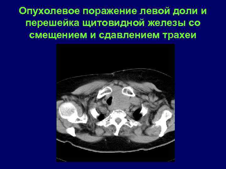 Опухолевое поражение левой доли и перешейка щитовидной железы со смещением и сдавлением трахеи 