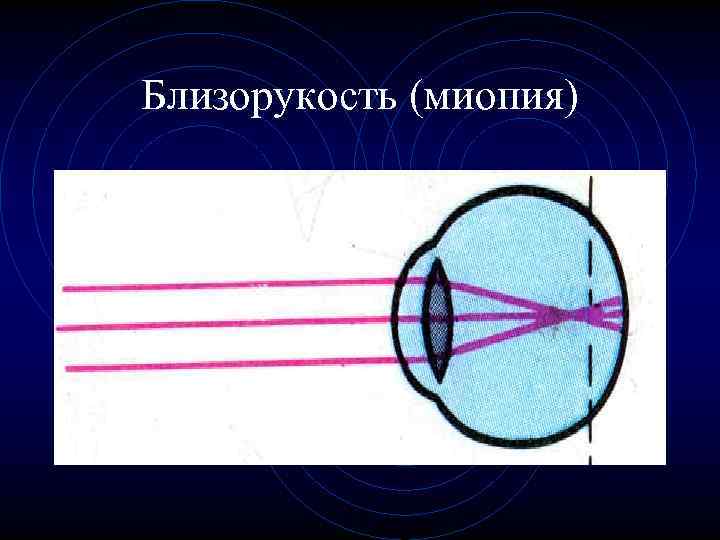 Близорукость (миопия) 
