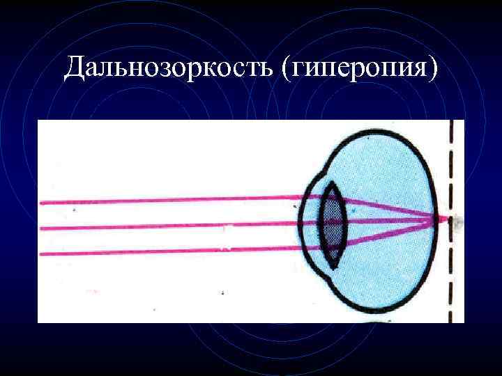 Дальнозоркость (гиперопия) 
