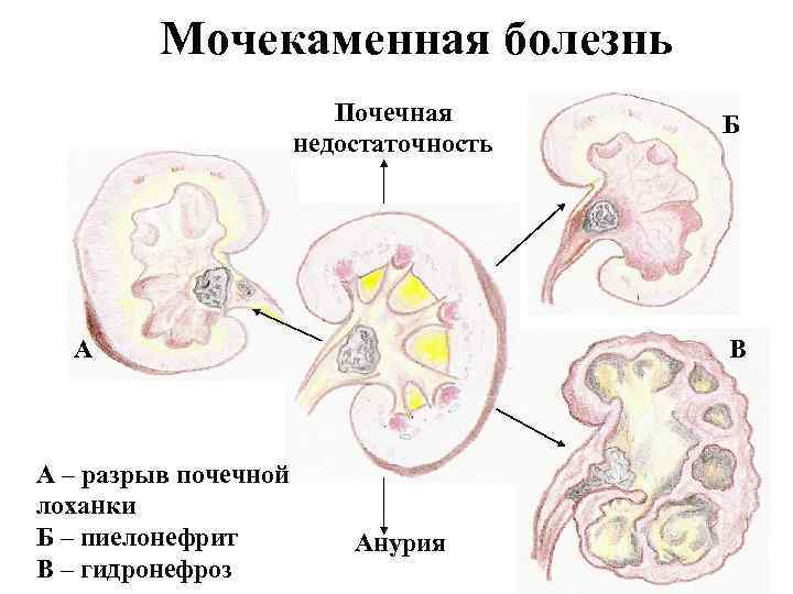 Мочекаменная болезнь Почечная недостаточность А А – разрыв почечной лоханки Б – пиелонефрит В