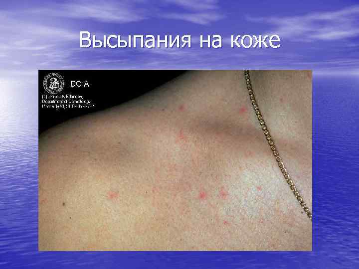 Высыпания на коже 