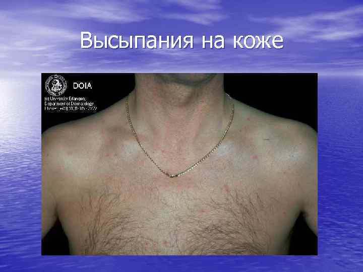 Высыпания на коже 