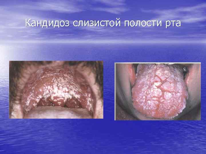 Кандидоз слизистой полости рта 