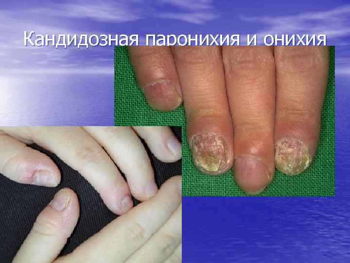 Кандидозная паронихия и онихия 