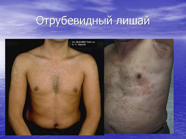 Отрубевидный лишай 