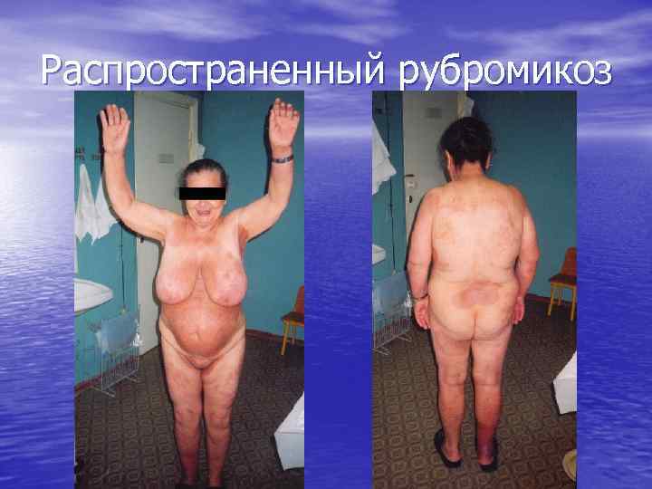 Распространенный рубромикоз 