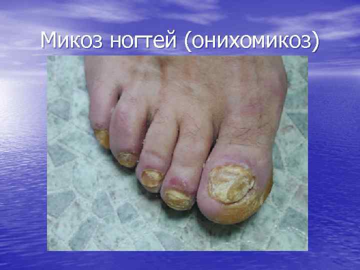 Микоз ногтей (онихомикоз) 