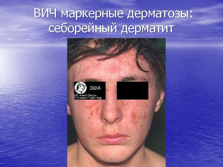 ВИЧ маркерные дерматозы: себорейный дерматит 
