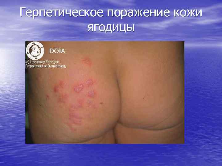 Герпетическое поражение кожи ягодицы 