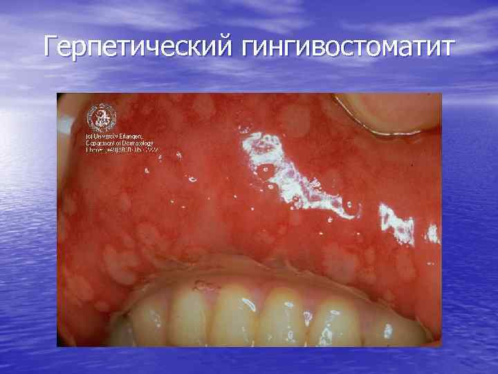Герпетический гингивостоматит 