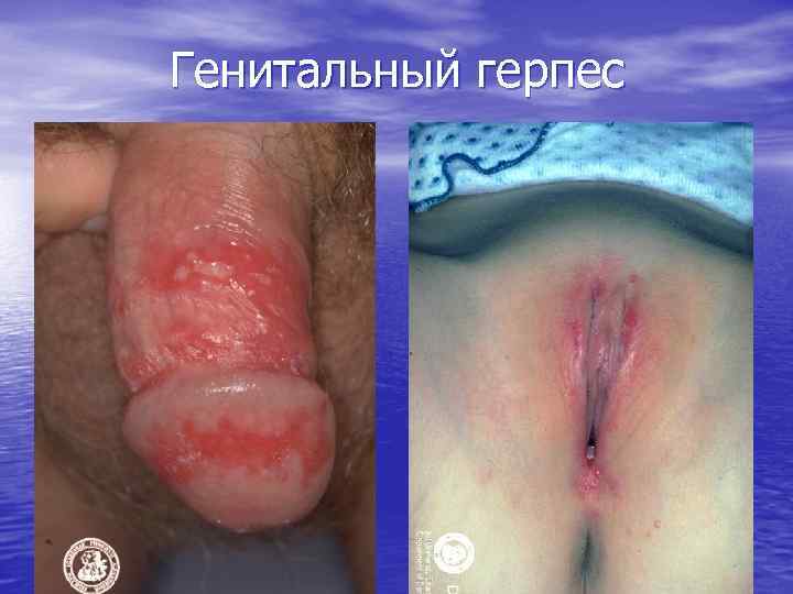 Генитальный герпес 