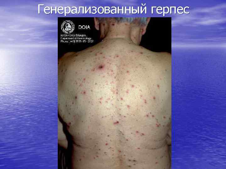 Генерализованный герпес 
