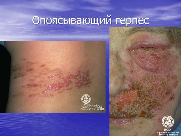 Опоясывающий герпес 