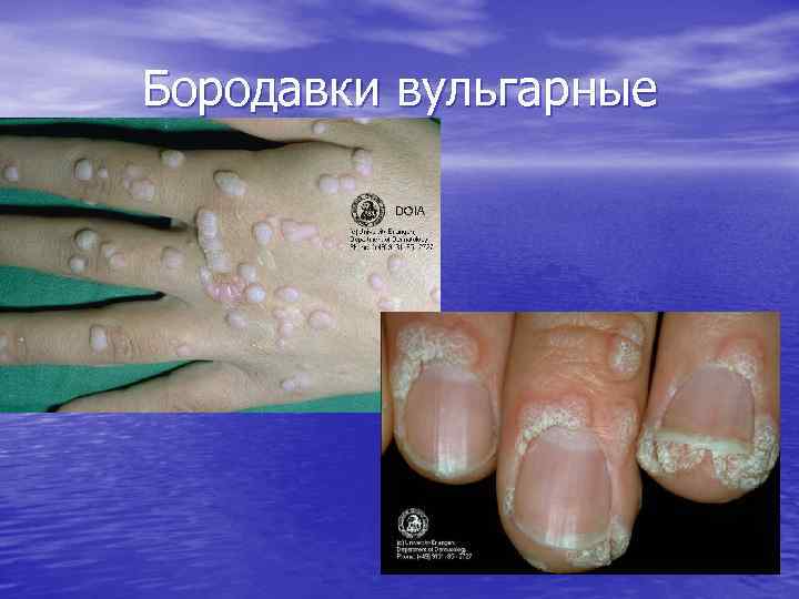 Бородавки вульгарные 