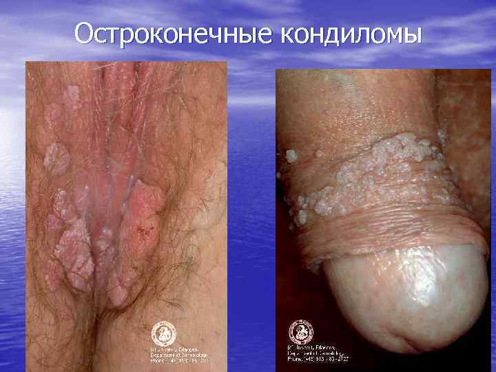 Остроконечные кондиломы 