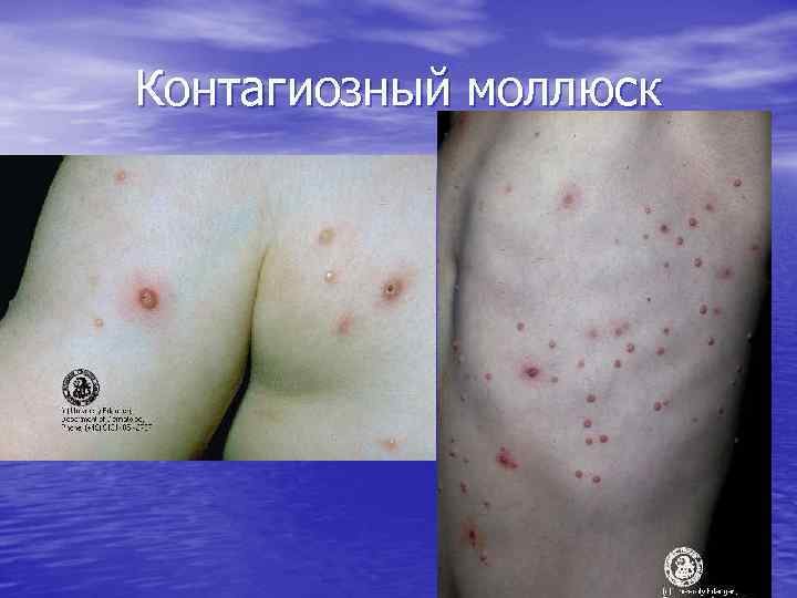 Контагиозный моллюск 