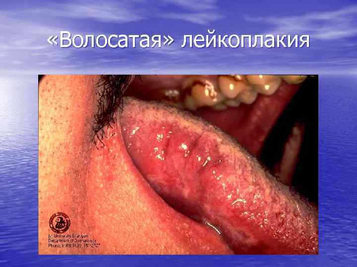  «Волосатая» лейкоплакия 