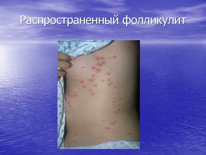 Распространенный фолликулит 
