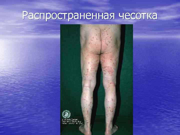 Распространенная чесотка 