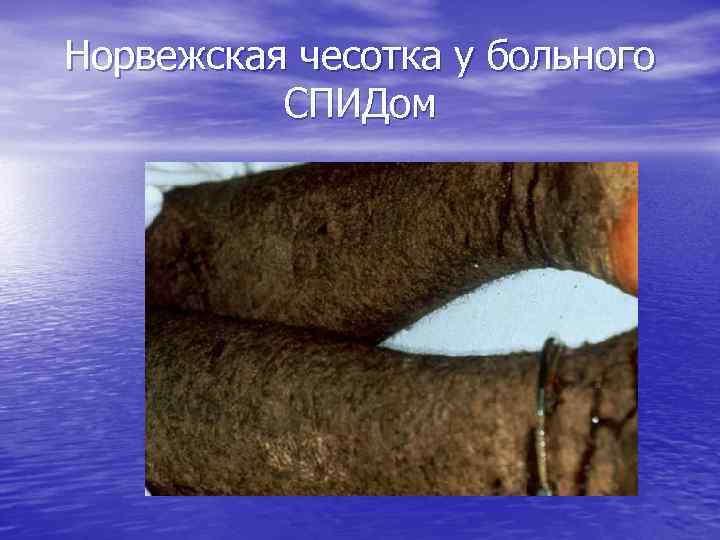 Норвежская чесотка у больного СПИДом 