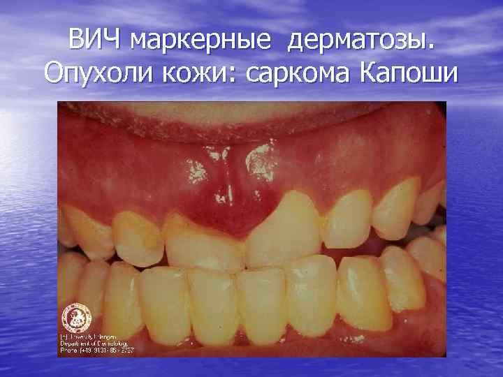 ВИЧ маркерные дерматозы. Опухоли кожи: саркома Капоши 