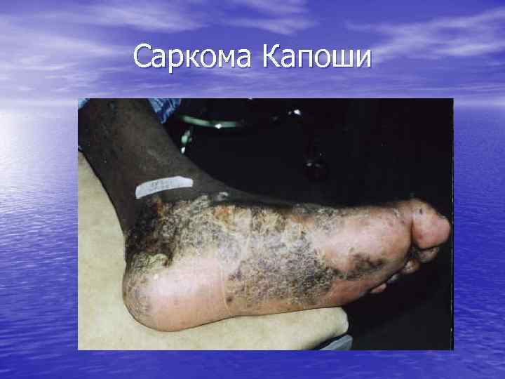 Саркома Капоши 