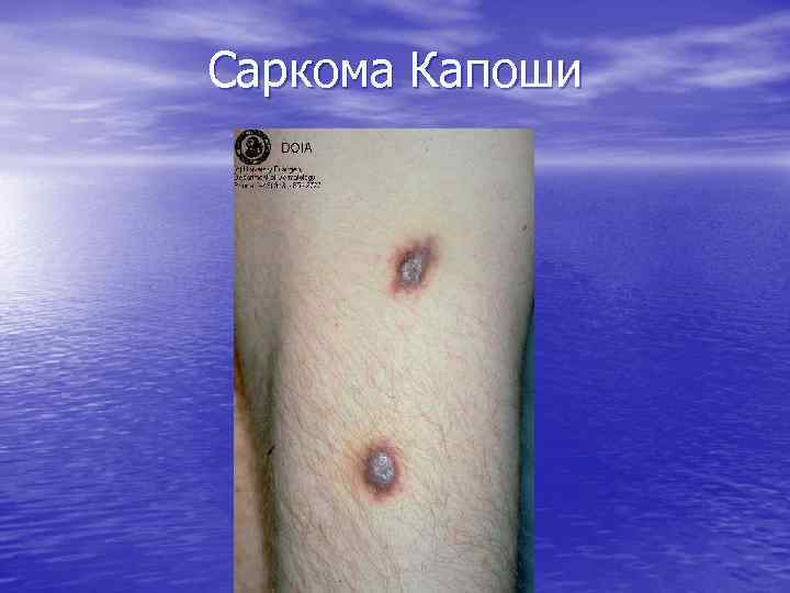 Саркома Капоши 