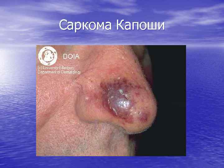 Саркома Капоши 