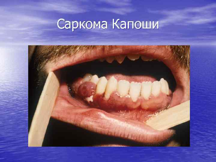 Саркома Капоши 