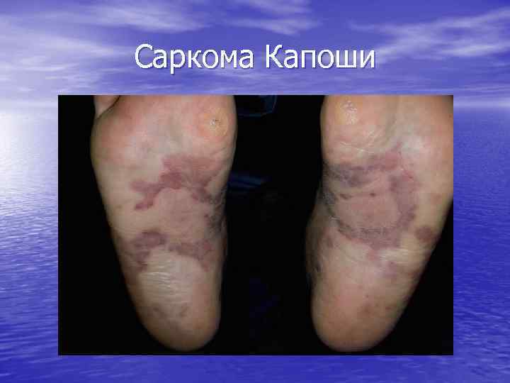 Саркома Капоши 