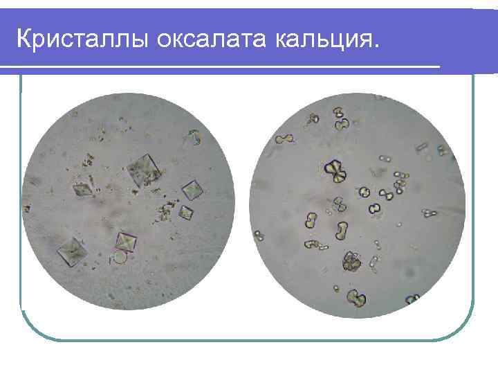 Кристаллы оксалата кальция в моче