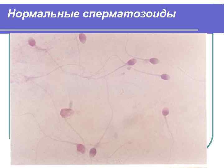 Нормальные сперматозоиды 