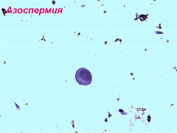 Азоспермия 