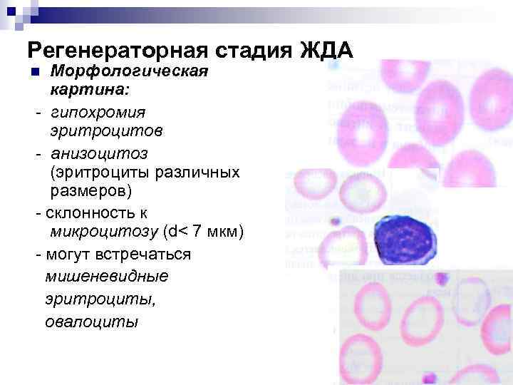 Регенераторная стадия ЖДА Морфологическая картина: - гипохромия эритроцитов - анизоцитоз (эритроциты различных размеров) -