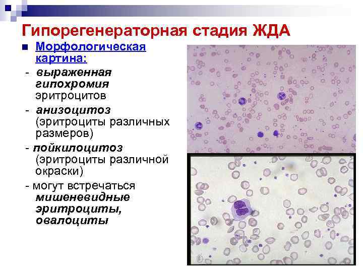 Гипорегенераторная стадия ЖДА Морфологическая картина: - выраженная гипохромия эритроцитов - анизоцитоз (эритроциты различных размеров)