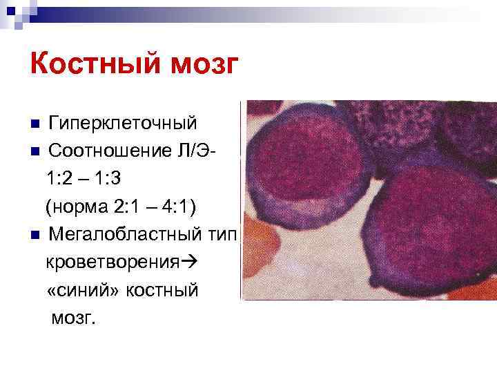 Костный мозг Гиперклеточный n Соотношение Л/Э 1: 2 – 1: 3 (норма 2: 1