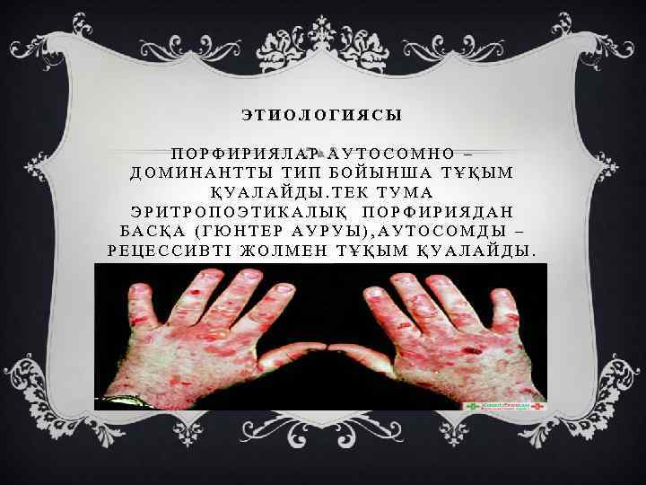 ЭТИОЛОГИЯСЫ ПОРФИРИЯЛАР АУТОСОМНО – ДОМИНАНТТЫ ТИП БОЙЫНША ТҰҚЫМ ҚУАЛАЙДЫ. ТЕК ТУМА ЭРИТРОПОЭТИКАЛЫҚ ПОРФИРИЯДАН БАСҚА