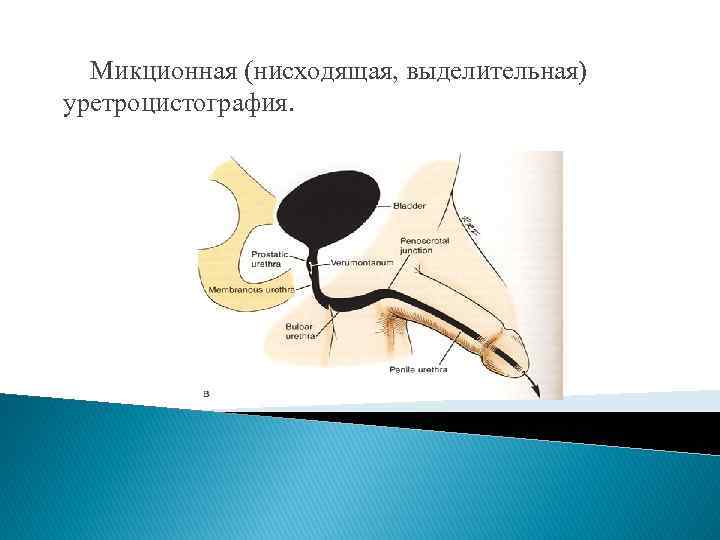Микционная (нисходящая, выделительная) уретроцистография. 