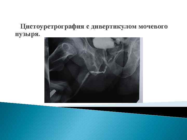 Цистоуретрография с дивертикулом мочевого пузыря. 