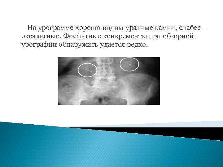 На урограмме хорошо видны уратные камни, слабее – оксалатные. Фосфатные конкременты при обзорной урографии
