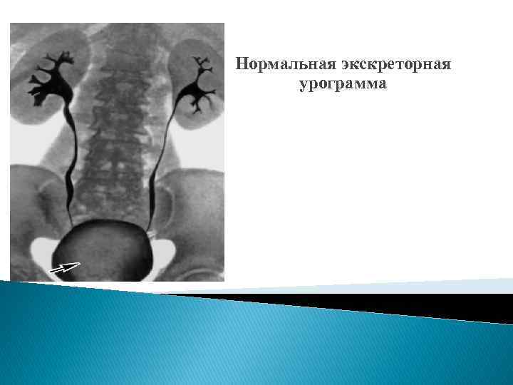 Нормальная экскреторная урограмма 
