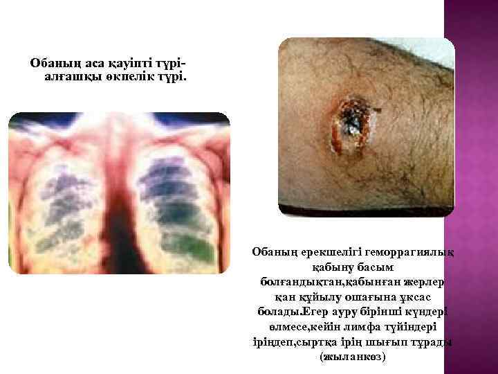 Обаның аса қауіпті түріалғашқы өкпелік түрі. Обаның ерекшелігі геморрагиялық қабыну басым болғандықтан, қабынған жерлер