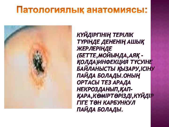 КҮЙДІРГІНІҢ ТЕРІЛІК ТҮРІНДЕ ДЕНЕНІҢ АШЫҚ ЖЕРЛЕРІНДЕ (БЕТТЕ, МОЙЫНДА, АЯҚ ҚОЛДА)ИНФЕКЦИЯ ТҮСУІНЕ БАЙЛАНЫСТЫ ҚЫЗАРУ, ІСІНУ