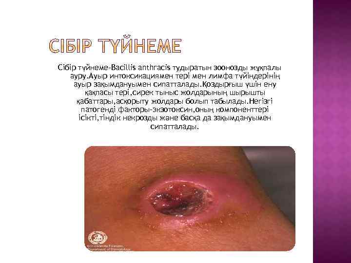 Сібір түйнеме-Bacillis anthracis тудыратын зоонозды жұқпалы ауру. Ауыр интоксикациямен тері мен лимфа түйіндерінің ауыр