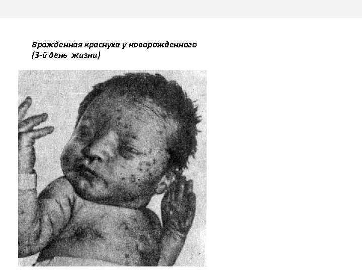  Врожденная краснуха у новорожденного (3 -й день жизни) 