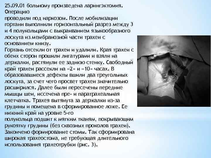 25. 09. 01 больному произведена ларингэктомия. Операцию проводили под наркозом. После мобилизации гортани выполнили