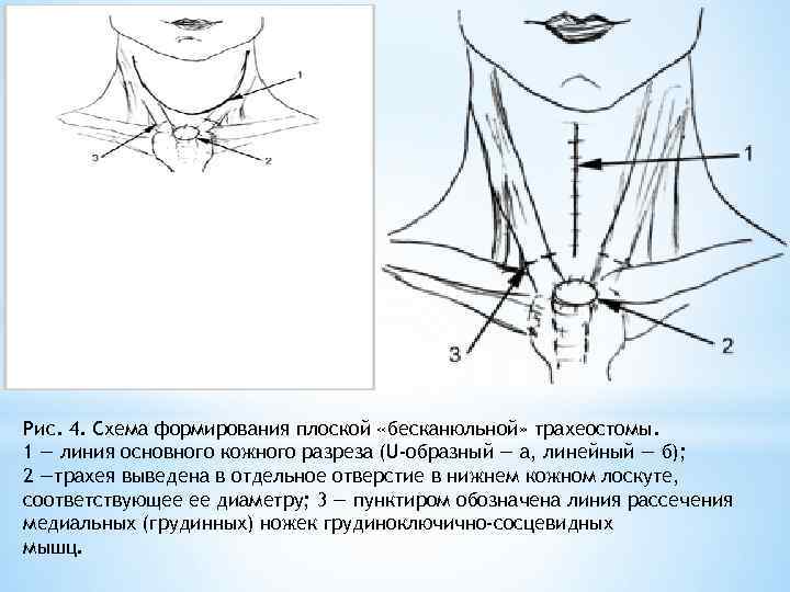 Трахеостома показания