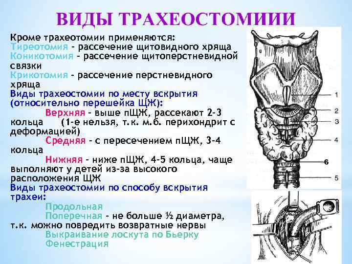 Трахеотомия показания