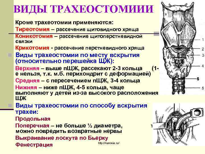 Трахеотомия. Верхняя трахеостомия Оперативная хирургия. Верхняя и нижняя трахеостомия топографическая анатомия. Коникотомия топографическая анатомия. Трахеостомия топографическая анатомия.